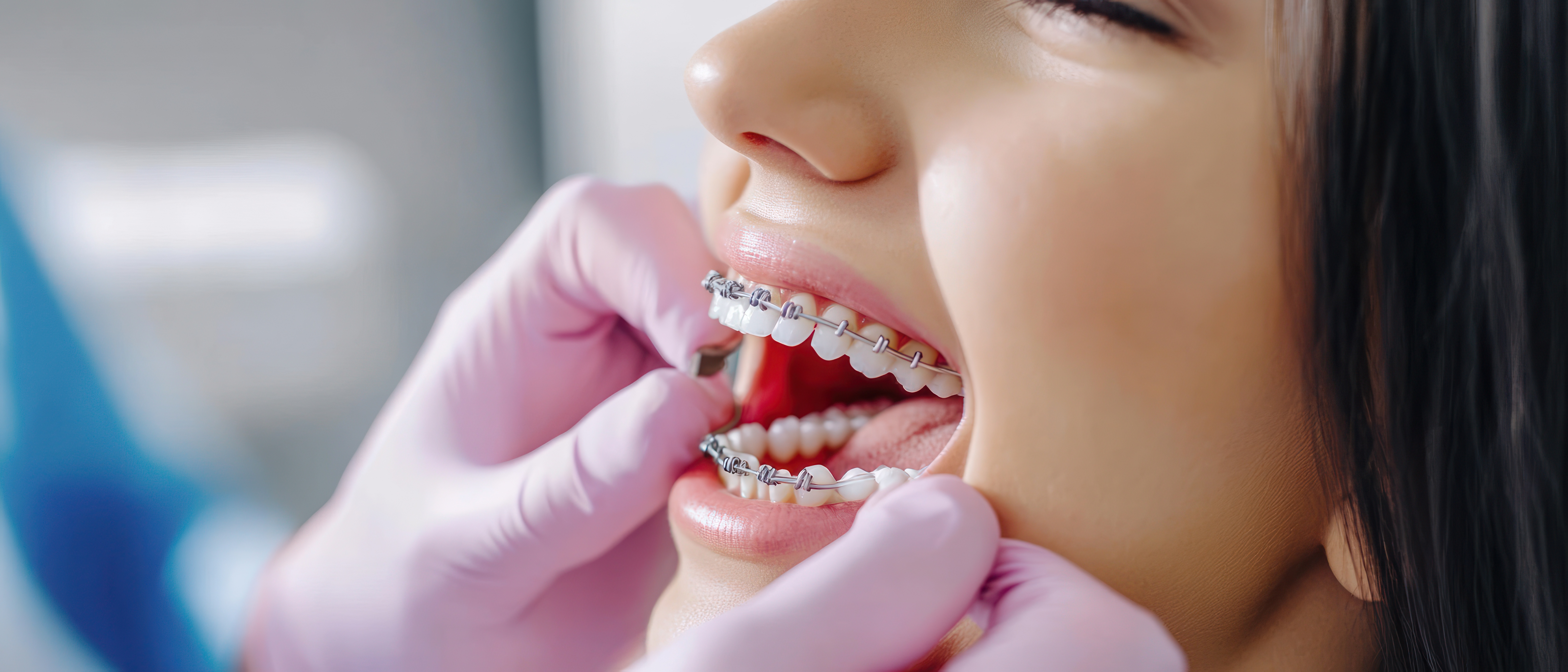 Braces Treatment