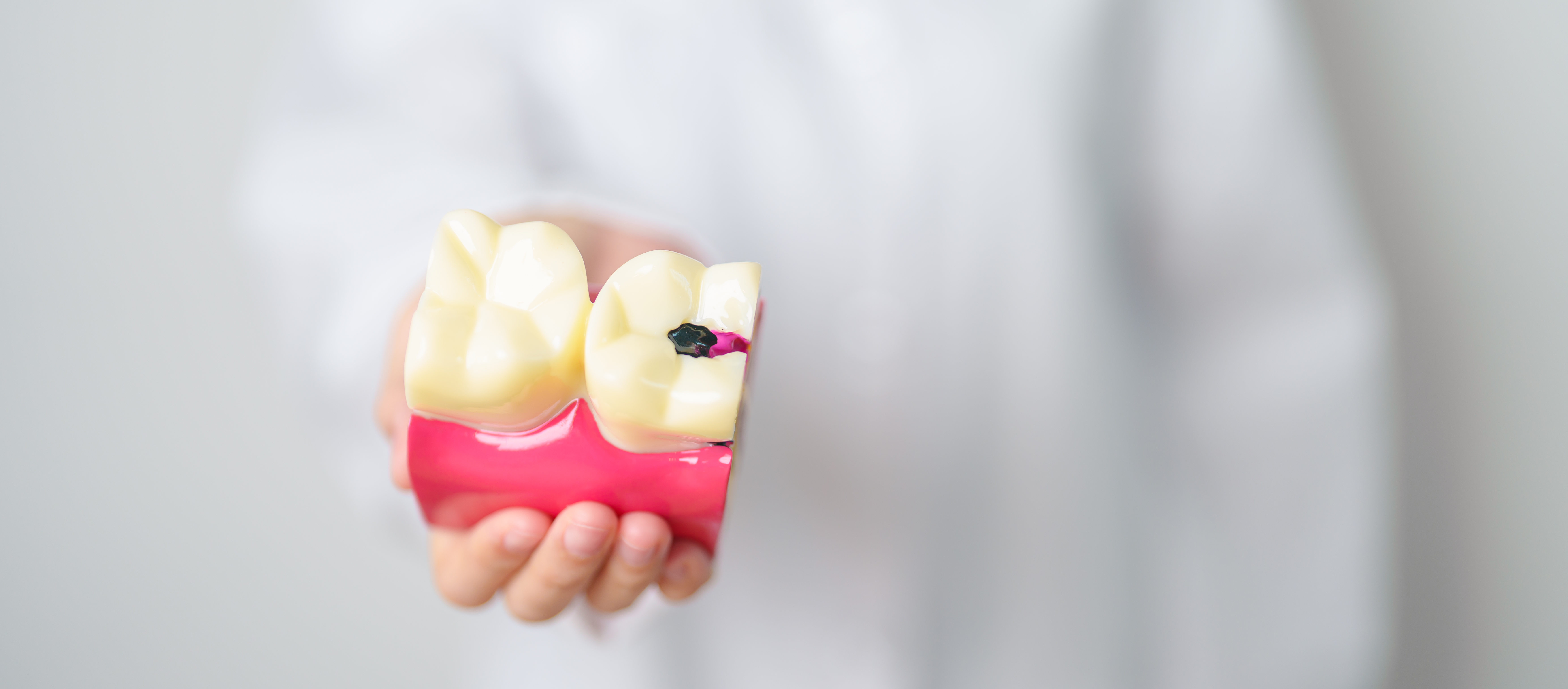 Tooth Colored Filling